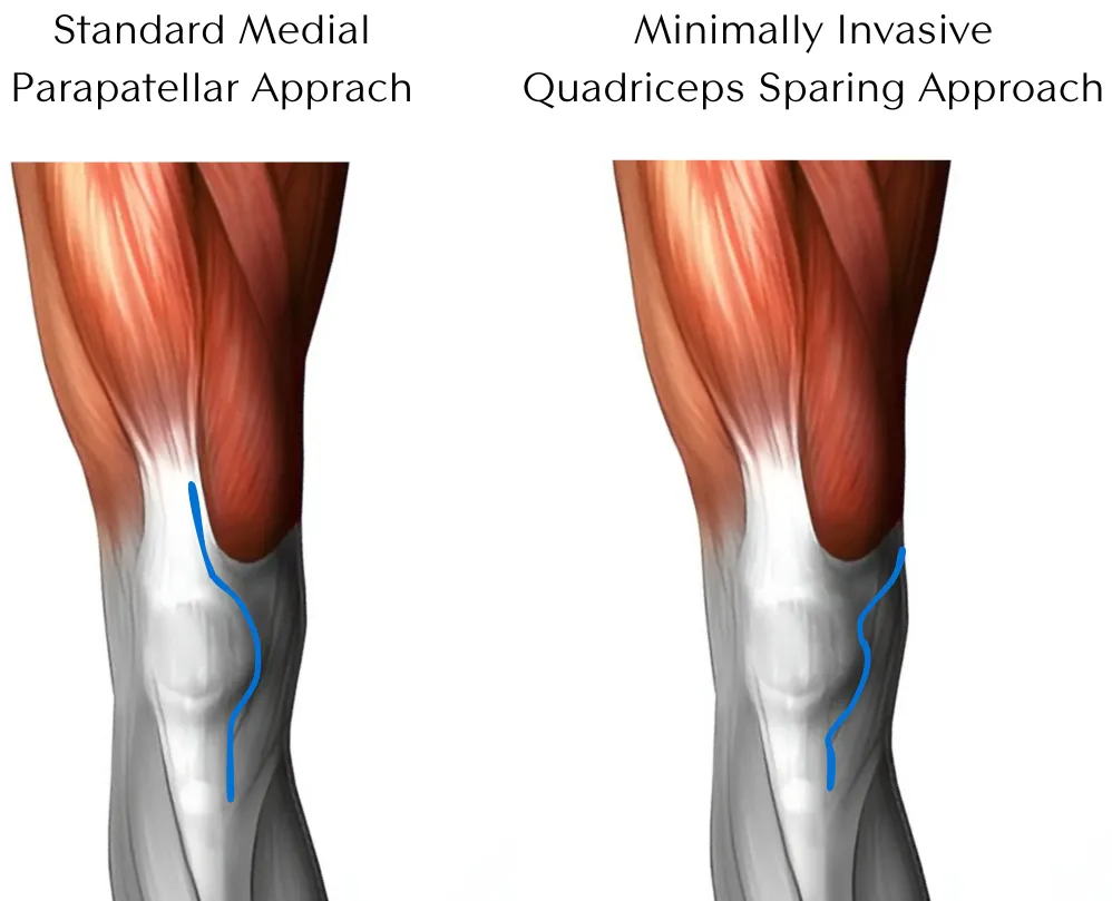 Comparison of the standard medial parapatellar approach and the minimally invasive, quadriceps-sparing subvastus approach for knee replacement